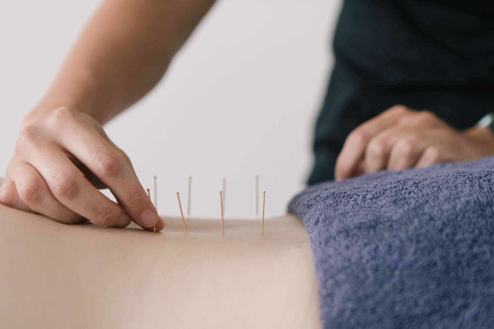 Needling at Live Well Health Centre