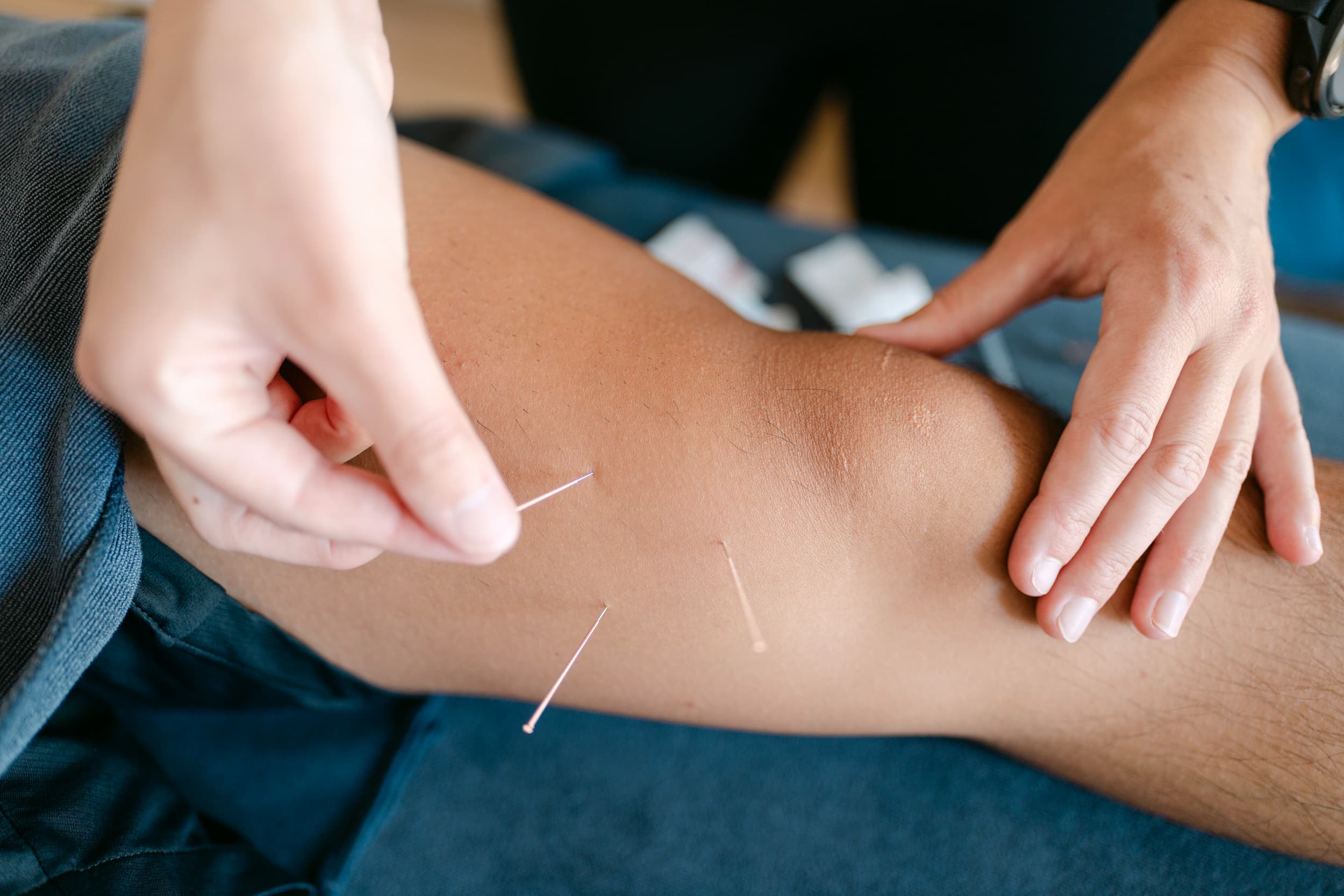 Close-up of multiple dry needles inserted into patient's leg for osteopathic trigger point treatment